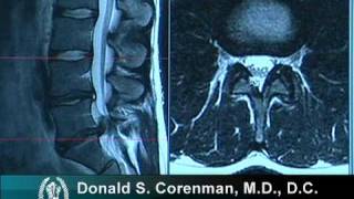 How to Read a MRI of a Lumbar Herniated Disc  Lower Back Pain  Colorado Spine Surgeon [upl. by Ogg]