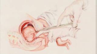 PartialBirth Abortion  Obama Debate Comments  Partial Birth Abortion Ban Video [upl. by Ronen119]