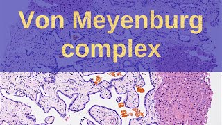 What are Von Meyenburg Complexes  Pathology mini tutorials [upl. by Song]