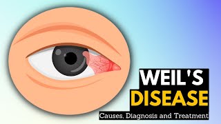 Weils Disease Causes Symptoms And Treatment [upl. by Tory]