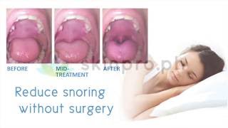 Skin Pro Fotona  Nightlase  Laser Snore Reduction Treatment [upl. by Rapsag188]