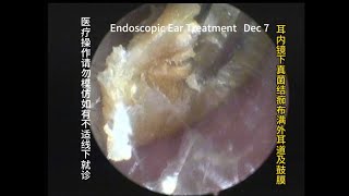 Appearance and treatment methods of fungal otitis externa 20231207 [upl. by Nahte]