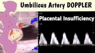 Ultrasound Umbilical Artery Doppler  Placental Insufficiency [upl. by Weatherley]