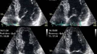 RAPID ATRIAL FIBRILLATION DOBUTAMINE INDUCED [upl. by Etireuqram]