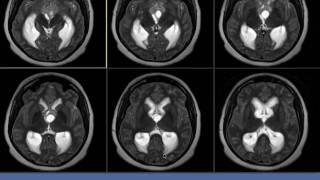 PostOperative Course  Germinoma  UCLA Pituitary Tumor Program [upl. by Anai]