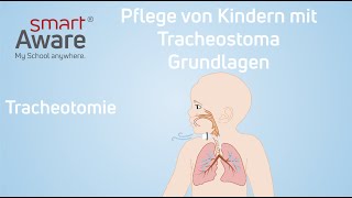 Pflege von Kindern mit Tracheostoma Tracheotomie  Pflegestandards Kinderkrankenpflege  smartAware [upl. by Partan212]