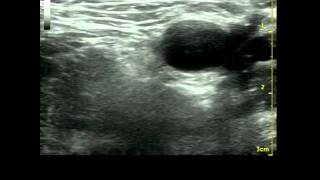 Femoral Nerve scanning compressing amp anisotropyMP4 [upl. by Leirda386]