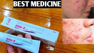 Clin 3 Gel Unboxing amp Review  चेहरा साफ करने और मुंहासे हटाने की Best दवा  Best Cream for Pimple [upl. by Tilford]