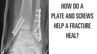 How does a plate and screws help a broken bone heal [upl. by Gone]