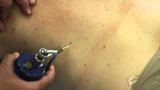 How to treat multiple Seborroheic Keratosis Warts on the back using Cryotherapy [upl. by Bigelow197]