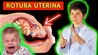 ✅ ROTURA UTERINA PARA PRINCIPIANTES SÍNTOMAS FISIOPATOLOGÍA Y MANEJO [upl. by Adnawyt449]