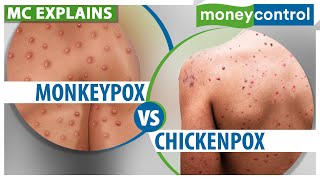 Monkeypox How Is It Different From Chickenpox  Explained [upl. by Ezitram]