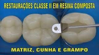 Restauração Classe II em Resina Composta  PARTE 1 [upl. by Apthorp]