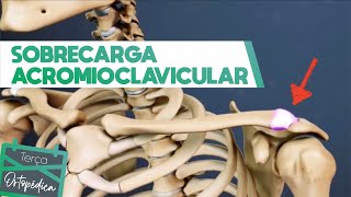 Sobrecarga Acromioclavicular Dr Eric Curi  Ortopedista Ombro e Cotovelo [upl. by Belayneh]