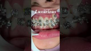 My Braces Story Before amp After Transformationbracesjourney braces [upl. by Jarrett324]