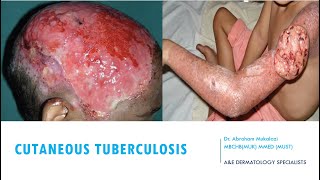 SKINCUTANEOUS TUBERCULOSIS BY DR ABRAHAM TB ulcers funny viralvideo education dermatology [upl. by Elleda579]