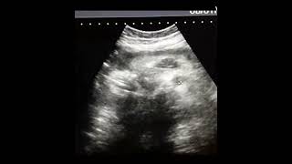 Breech l Female sex l Placenta previa 😱😱😱l 2 doctor ultrasound pregnancycomplication [upl. by Zetrok]