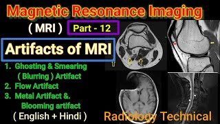 MRI Part 12  Artifacts of MRI  Ghosting amp Smearing artifact  Flow artifact  Metal Artifact [upl. by Tehcac]