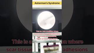 Ashermans Syndrome scar tissue or intrauterine adhesions inside uterus drrakshitamalik doctor [upl. by Avat]