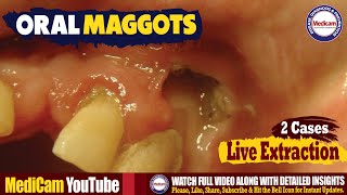 Oral Maggots Myiasis Infestation  Causes and Extraction [upl. by Antonin]