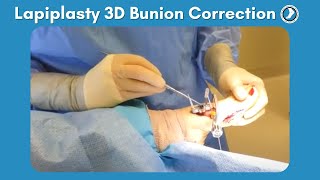 Lapiplasty Procedure  3D Bunion Correction with Dr Paul Steinke [upl. by Linad]