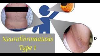 Neurofibromatosis mrcpch Clinical General Examination [upl. by Ahsed]