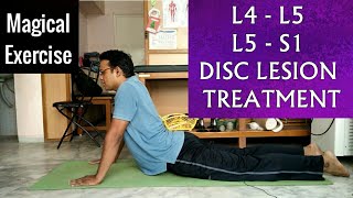 L 4L 5 amp L 5S 1 SLIPPED DISC Treatment  One EXERCISE To Cure LUMBER SLIPPED DISC completely [upl. by Hashimoto]