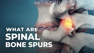 What Are Spinal Bone Spurs  Atlantic Spine Center [upl. by Idnor]