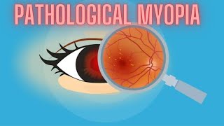 Pathological Myopia  High Myopia  Ophthalmology Lecture [upl. by Eliot202]