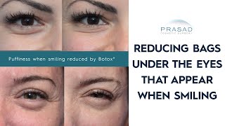 How Bags Under Eyes When Smiling can be Treated [upl. by Adnahsal]