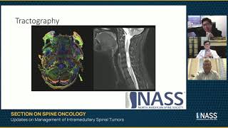 Updates on Management of Intramedullary Spinal Tumors [upl. by Lisa]