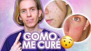 YO SUFRI DE ACNE  Mi experiencia y como me curé  Recomendaciones consejos y mas [upl. by Danie]