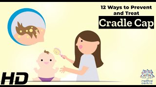 Cradle Cap Solutions 12 Effective Ways to Prevent and Treat It [upl. by Yvel695]