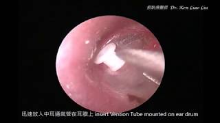 中耳炎之中耳積水內視鏡通氣管置入 endoscopic ventilation tube insertion for middle ear effusion [upl. by Dilisio111]