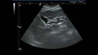 Advanced LC with splenomegaly [upl. by Hernando]