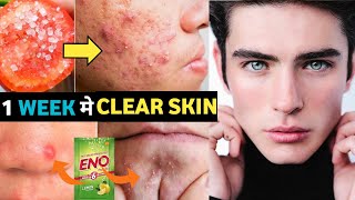 7 Face Destroying Habits Abhi STOP Karo  Pimple Dark Spots Removal Home Remedies [upl. by Lanza600]