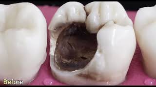 Root canal treatment procedure and a gold crown [upl. by Fleur]