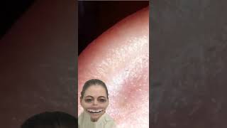 Blackheads Removal  Acne Treatment and Very Satisfying Satisfying Pimple pop blackheads [upl. by Geralda806]