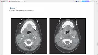 NEURORADIOLOGY EXAM CASES LECTURE [upl. by Aynwad]