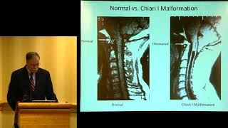 quotSyringomyelia Update Diagnosis Treatment and Researchquot  John D Heiss MD [upl. by Healion]