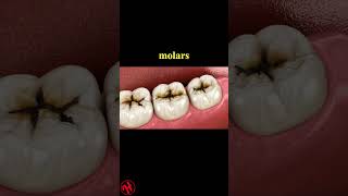 Molar teeth damaged by caries dentist healthandfitness [upl. by Veradia]