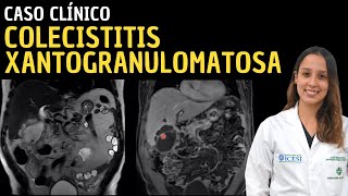 Caso clínico 110 Colecistitis xantogranulomatosa [upl. by Orme100]