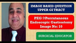 PERCUTANEOUS ENDOSCOPIC GASTROSTOMY UPPER GI TRACT Image Based Question [upl. by Eseilana]