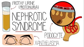 Nephrotic Syndrome Explained Clearly [upl. by Mccully]