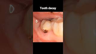 Filling tooth decay process dentistry dentist filling tooth [upl. by Eidderf]