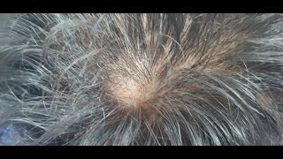 Pilar Trichilemmal Cyst Scalp Bloodless clean excision [upl. by Alvy]