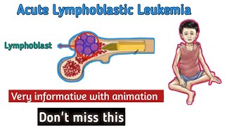 Acute Lymphoblastic LeukemiaALL  clinical presentation of ALL diagnosis of ALL Treatment of ALL [upl. by Alvy233]