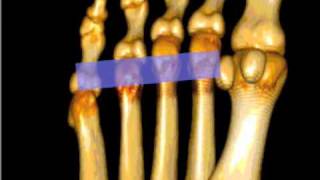 How To Mortons Neuroma Case Study Video [upl. by Holmes]