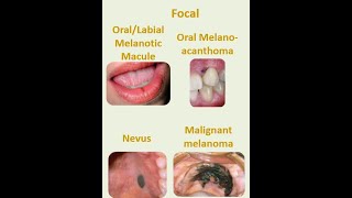 8 Focal melanosis [upl. by Petronilla]