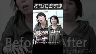 cervicaldystonia dystonia torticollis accident [upl. by Naitsirt]